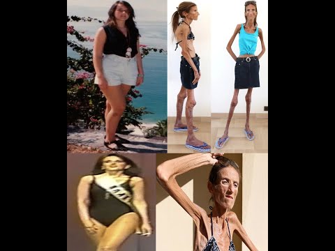 ملكة جمال روسيا التي تحولت لهيك ل عظ مي متحرك لسبب س اذج قصة أنحف امرأة في العالم