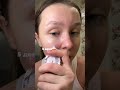 Лучшая мазь от прыщей