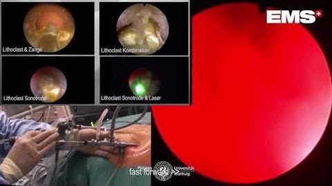 PNL   Swiss LithoClast Master   Ultrasound Lithotripsy