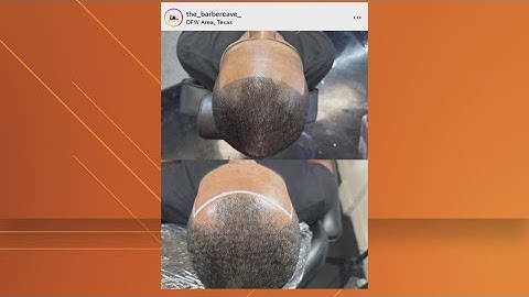 What is scalp micropigmentation? Texas barbershop owner, client speak on hair loss treatment