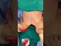 A tummy tuck after losing 100 pounds!