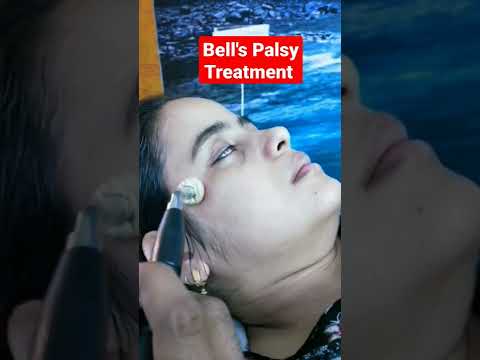 Bell&#39;s Palsy treatment #shorts #bellspalsy #physiotherapy