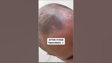 Do this before getting Scalp Micro Pigmentation #smp