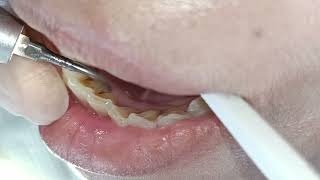 Teeth Cleaning Videos, Top Dentist ASMR, Dental treatment, Bracket Teeth, Tooth Braces by Dr Yayayue (牙牙月姐) 9 views 4 months ago 2 minutes, 58 seconds