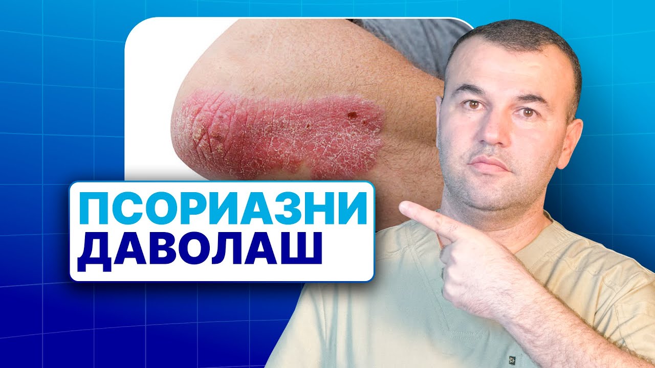 Псориаз касаллигини даволаш |  90 788 83 13