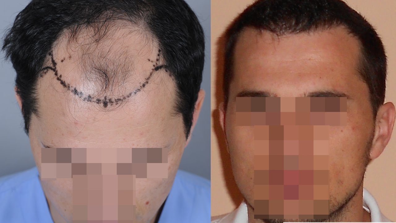Dr.Erkan Demirsoy 3621 Grafts Fue Before After Photos - YouTube