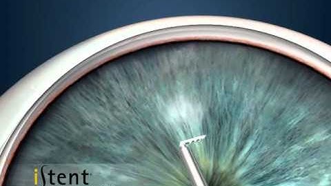 iStent Trabecular Micro-Bypass