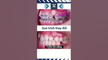 Mô phỏng quá trình niềng răng thực tế. #nhakhoacanthonew #newdental