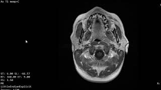 CASE 1007 MRI HEAD & NECK NEOPLASM