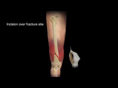 Video: ORIF-Chirurgie: Offene Reduktion Interne Fixation Für Gebrochene Knochen