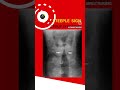 NORCET 2024 l Pediatric mcq l croup syndrome l epiglottitis l Ibq norcet 2024 l learnextnursing