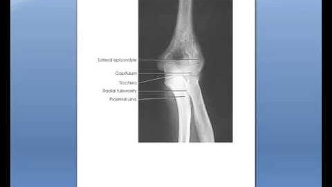 Trauma AP Elbow partial flexion