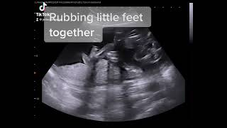 Baby rubbing feet together, 2D Ultrasound #jerbearimaging #babymovements www.JerBearImaging.com