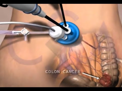 Single Incision Laparoscopic Colectomy utilizing SILS port - 3D Medical Animation