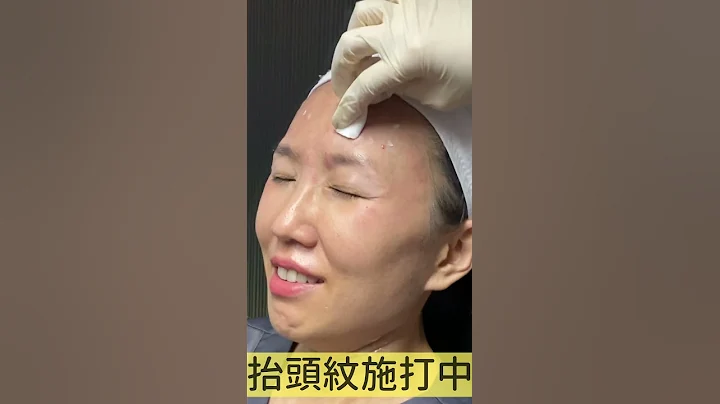 臉部老化的魚尾紋、皺眉紋、抬頭紋，莊盈彥醫師首選注射肉毒桿菌！ #shorts - 天天要聞