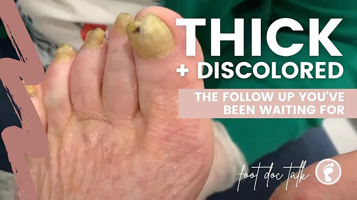 The THICK + DISCOLORED follow up you've been waiti...