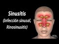 Sinusitis, Animación. Alila Medical Media Español.