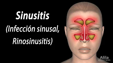 ¿Qué es lo mejor que se puede beber cuando se tiene una sinusitis?