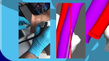 Central Vascular Access Short Axis Technique