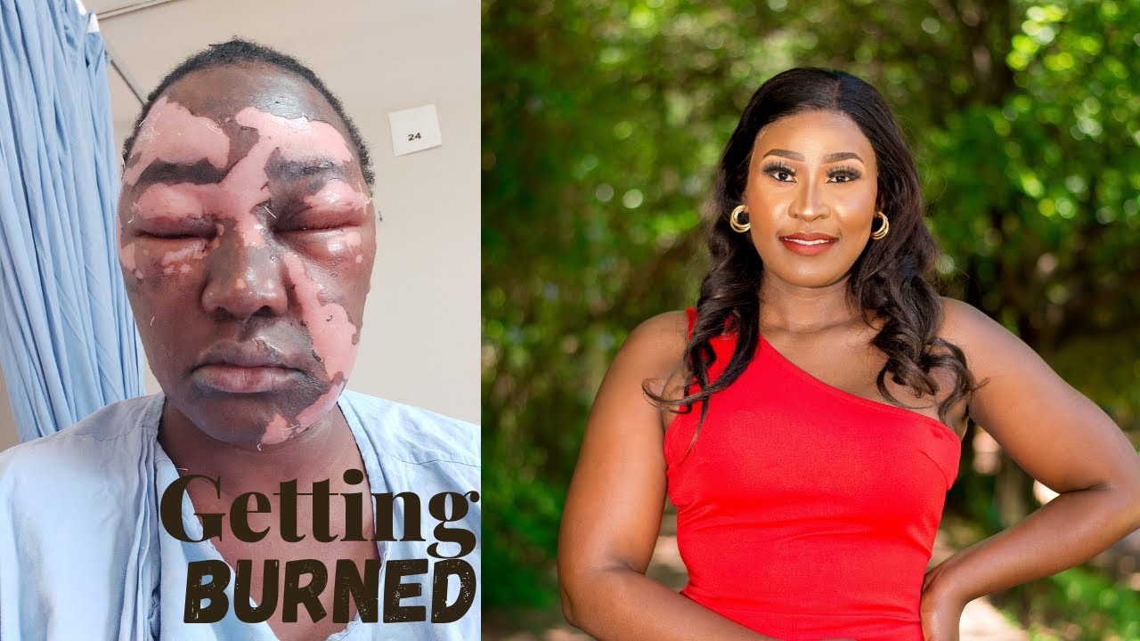 STORY TIME How I got Burned by Hot Oil YouTube