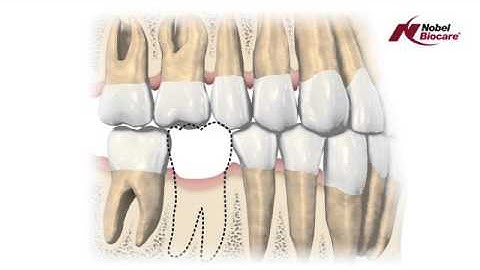 Consequences of missing teeth
