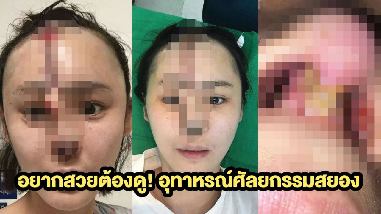 พิษศัลยกรรม สาวเกาหลีจมูกเน่า | 18-11-59 | เช้าข่าวชัดโซเชียล | ThairathTV