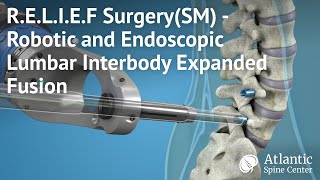 R.E.L.I.E.F Surgery (SM) - Robotic and Endoscopic Lumbar Interbody Expanded Fusion
