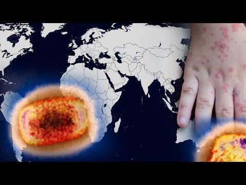 მაიმუნის ყვავილის გლობალური საფრთხე | სპეციალისტების პროგნოზი