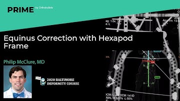 Equinus Correction with Hexapod Frame - Philip McClure, MD