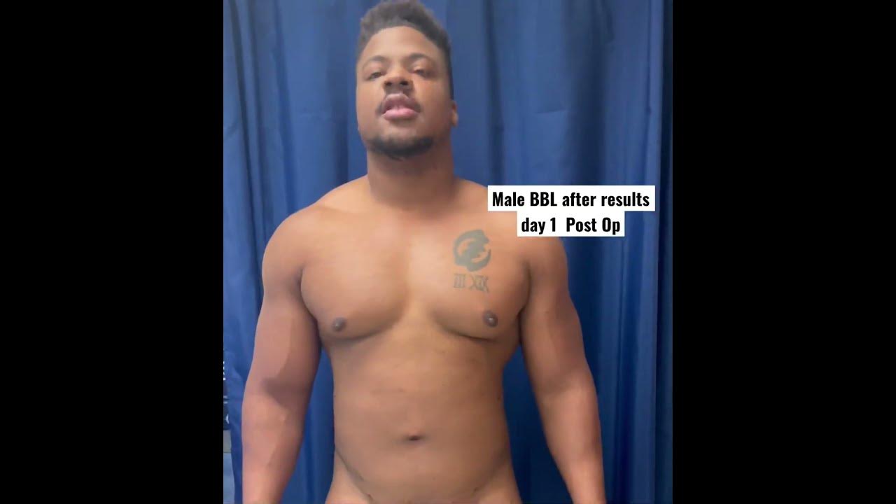 Male BBL after results day 1 Post Op YouTube
