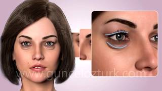 Alt - Üst Göz Kapağı Estetiği Ameliyatı (Blefaroplasti) Nasıl Yapılır ?  Dr. Güncel Öztürk - #DRGO