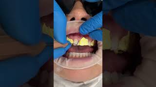 Direct composite bonding on the 8 upper teeth 🤍✨