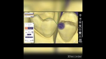 onlay design on exocad