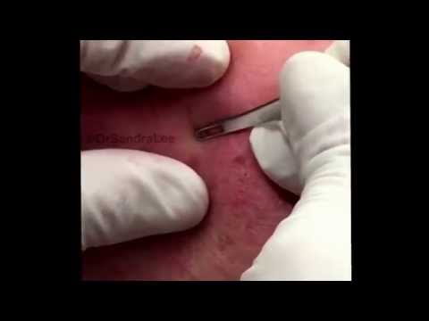 Acne Blackheads Extracted, Dr Sandra Lee. For Medical Education- NSFE.