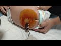 Lumbar puncture lp procedure  spinal fluid tap