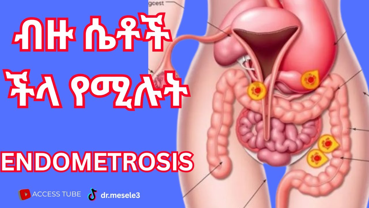 ስለ ኢንዶመትሮሲስ ማወቅ ያለባቹህ  ወሳኝ ምልክቶች /Signs of Endometriosis/