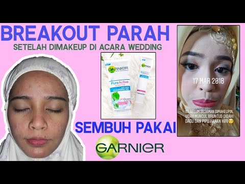 Skincare Murah untuk kulit berjerawat || Review Garnier Pure Active Sensitive. 