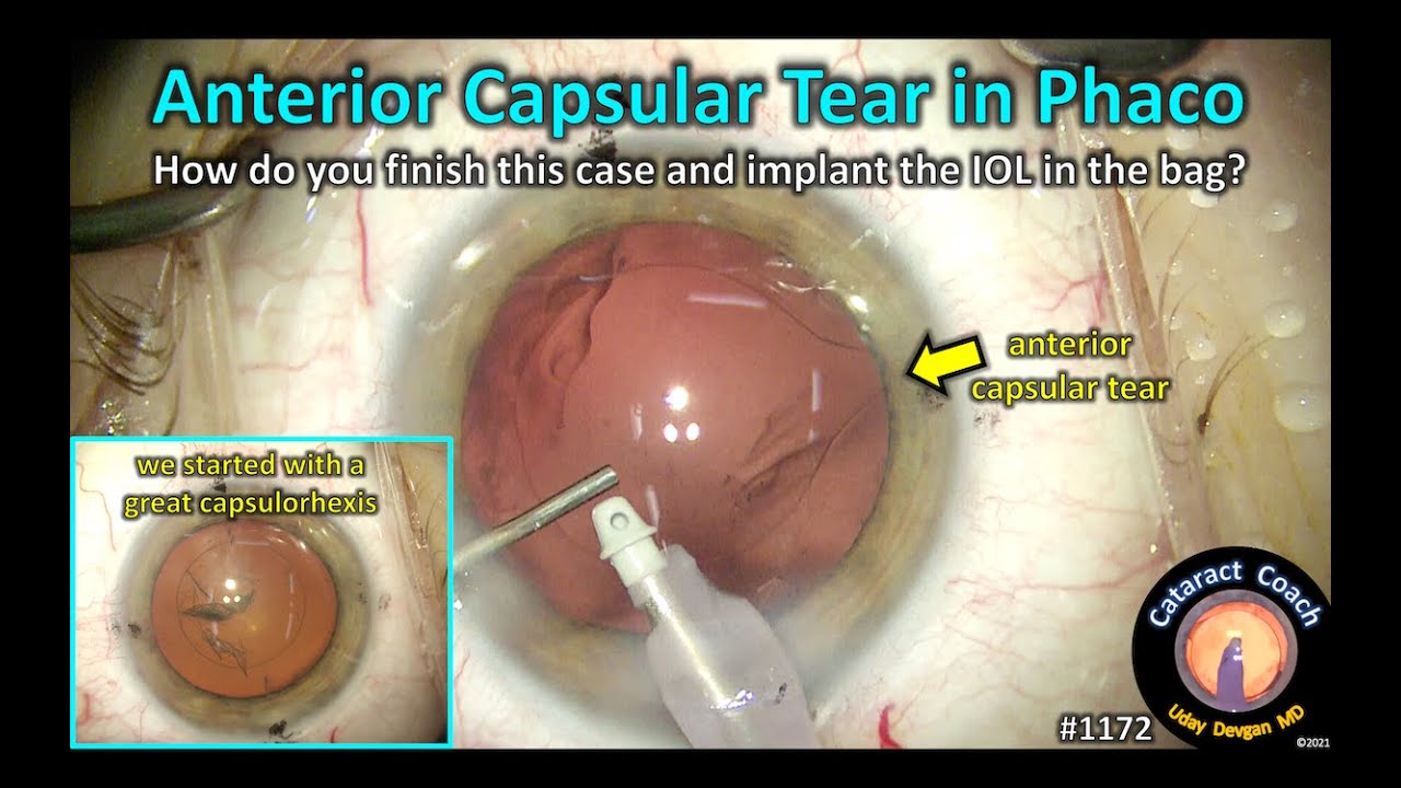 Cataract Surgery Procedures - Zeiss