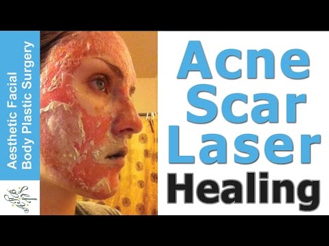 Acne Scar Laser Healing Diary:  Video with Images, Live Demo Cleaning after the Acne Scar Vitalizer