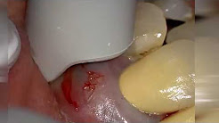 Pimple Inside The Mouth