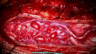 In Situ Occlusion of a Conus Medullaris Spinal Arteriovenous Malformation