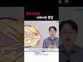 관내유두종 유두분비물 유두에서출혈 관내유두종 유두분비물 유두에서출혈