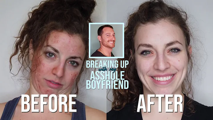 Get Better Skin By Dumping Your Boyfriend!
