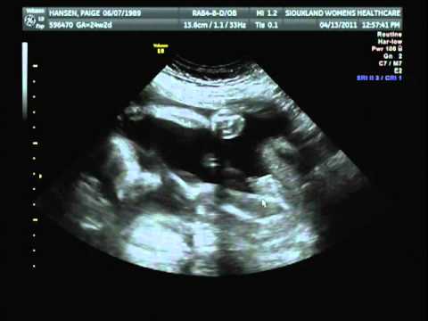 4d Ultrasound 24 Weeks 2 Days It S A Boy Youtube