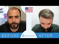 Hair transplant before and after turkey   dr bayer clinics