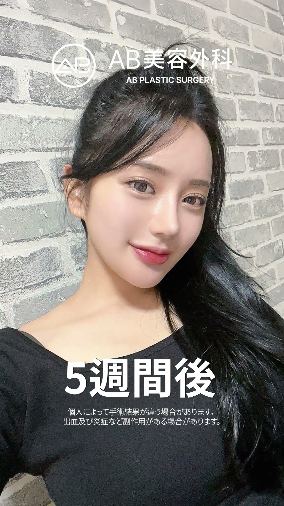 普通から美の女神へ：驚きの変身ビフォーアフター✨💖#韓国整形 #美容