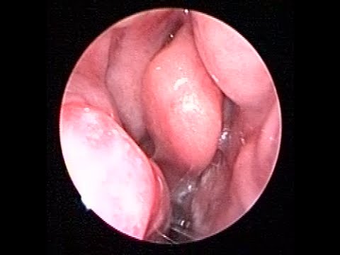 purulent nasal drainage