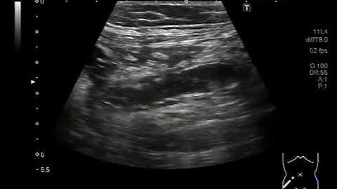 Ultrasound Video showing focusing of inflamed Appendix.