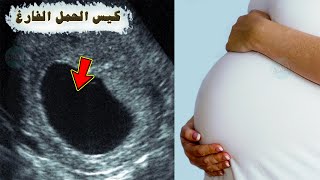 أعراض كيس الحمل الفارغ، ومتى ينزل ؟