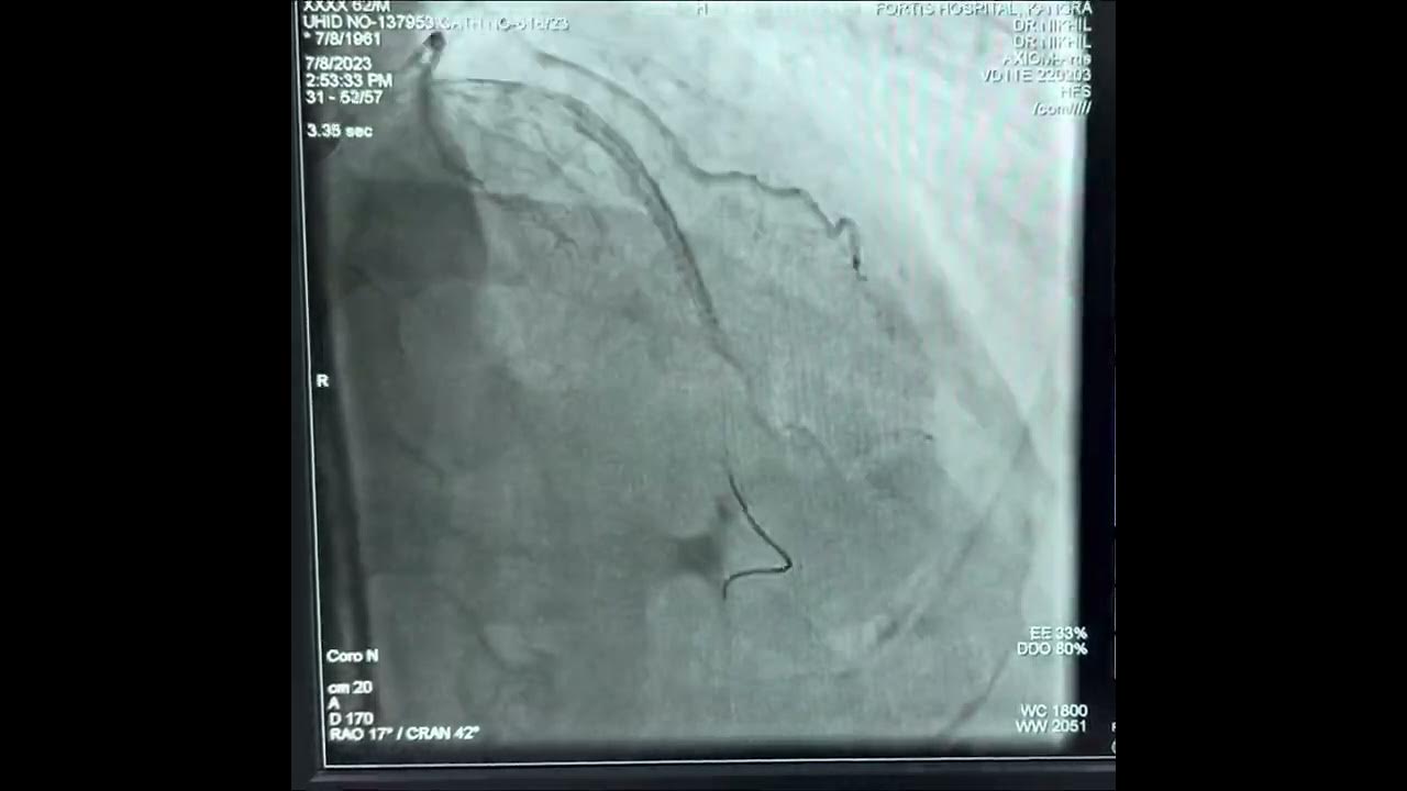 Case 2 IVUS Coronary artery perforation, ping pong technique, covered